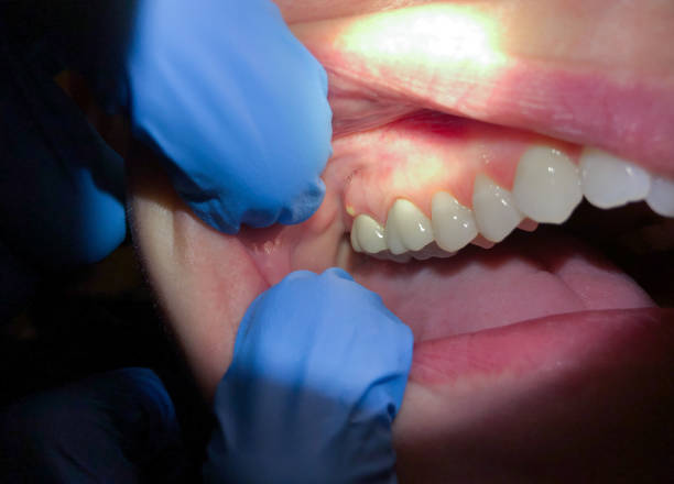Best Broken or Chipped Tooth Repair in Graton, CA